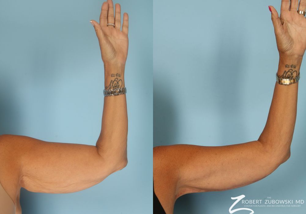 Brachioplasty - Case 3515