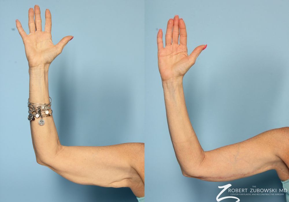Brachioplasty - Thumbnail 2