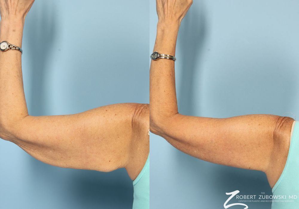 Brachioplasty - Case 3514