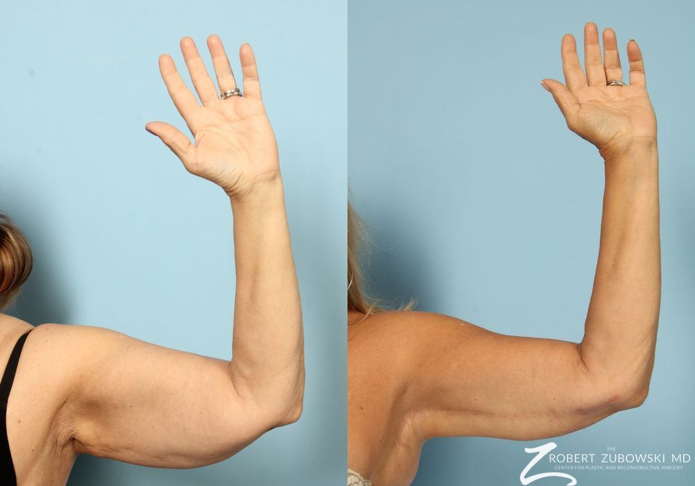 Brachioplasty - Thumbnail 2