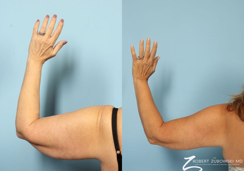 Brachioplasty - Thumbnail 3