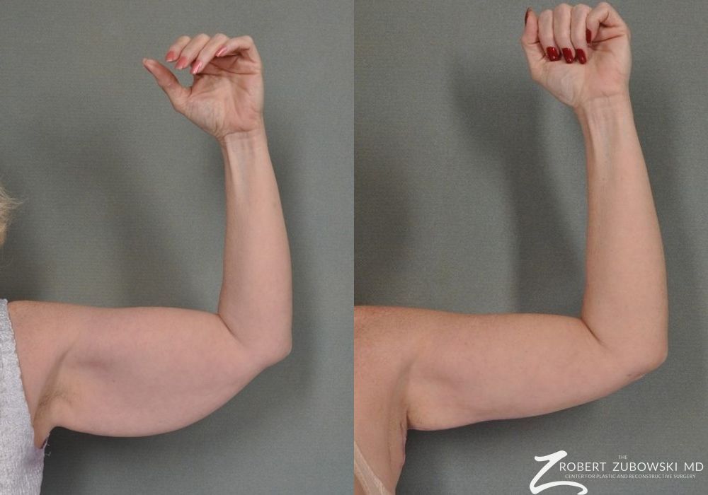 Brachioplasty - Thumbnail 2