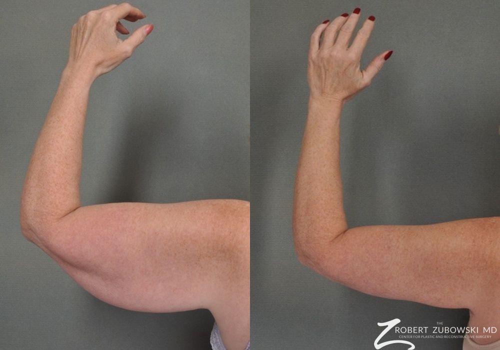 Brachioplasty - Case 3513