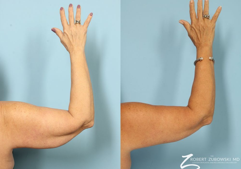 Brachioplasty - Thumbnail 4