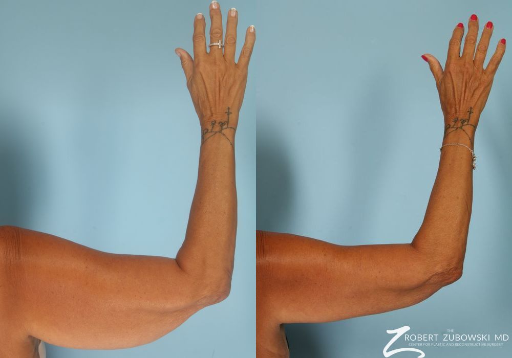 Brachioplasty - Thumbnail 2