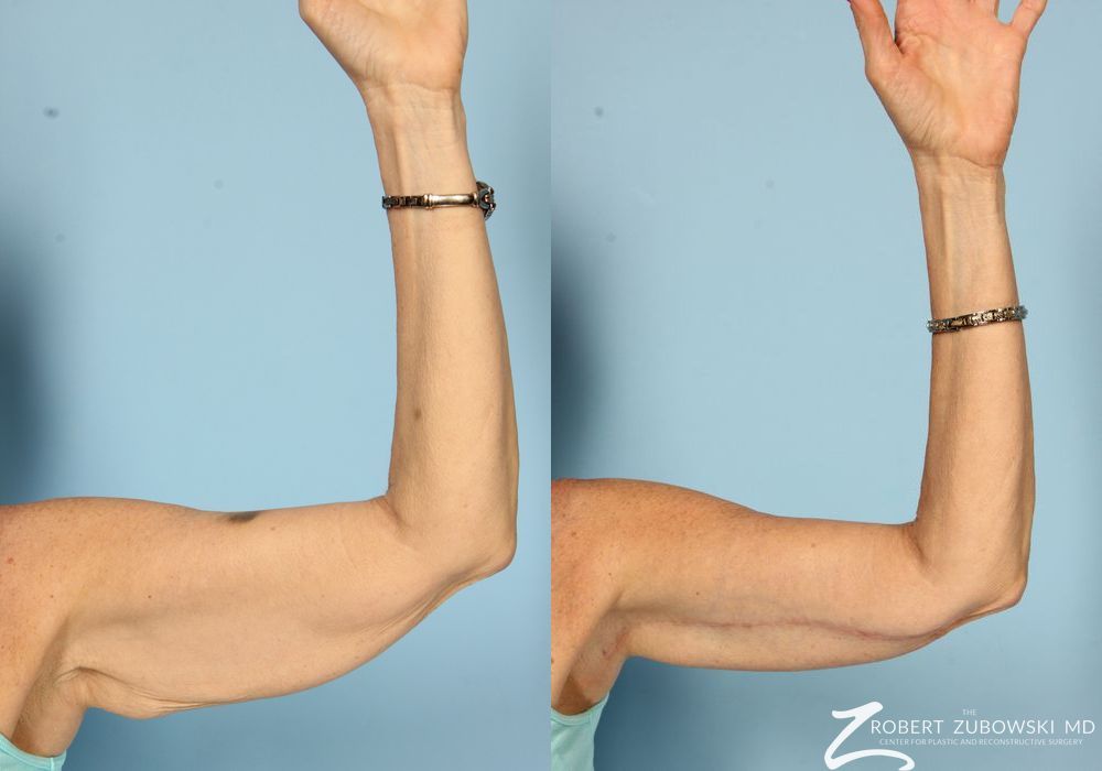 Brachioplasty - Thumbnail 3