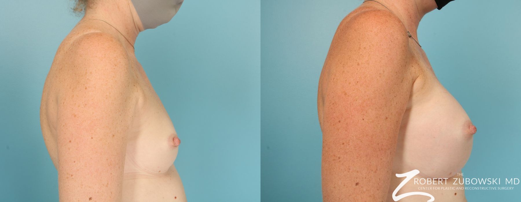 Breast Augmentation - Thumbnail 2