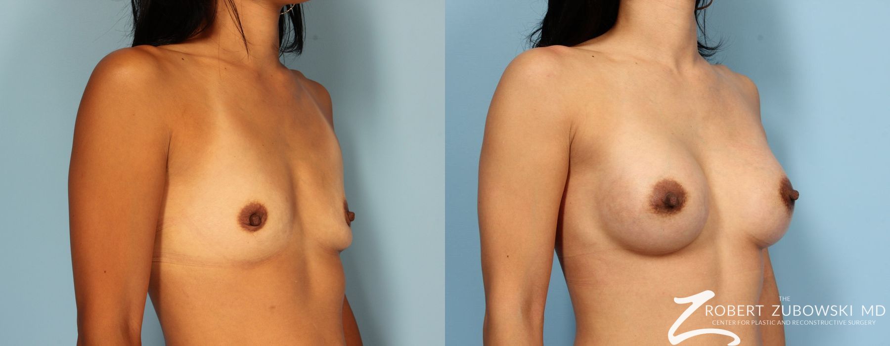 Breast Augmentation - Thumbnail 3