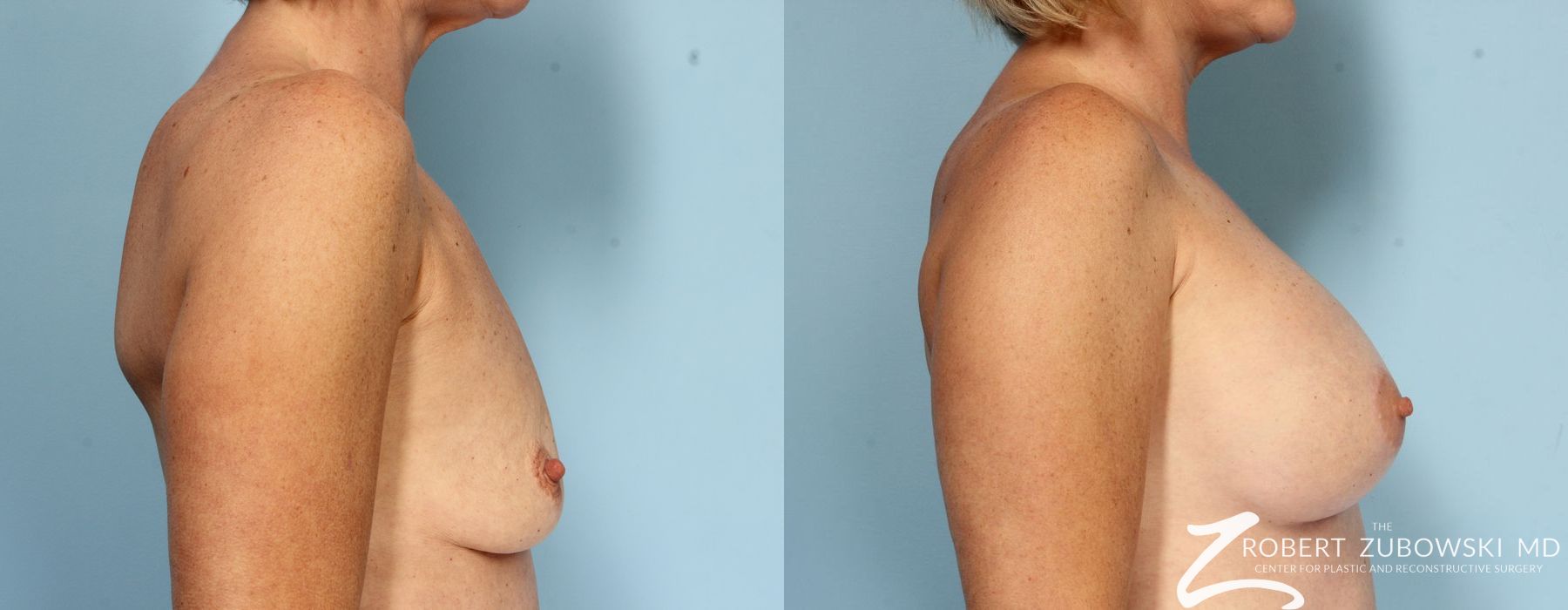 Breast Augmentation - Thumbnail 2