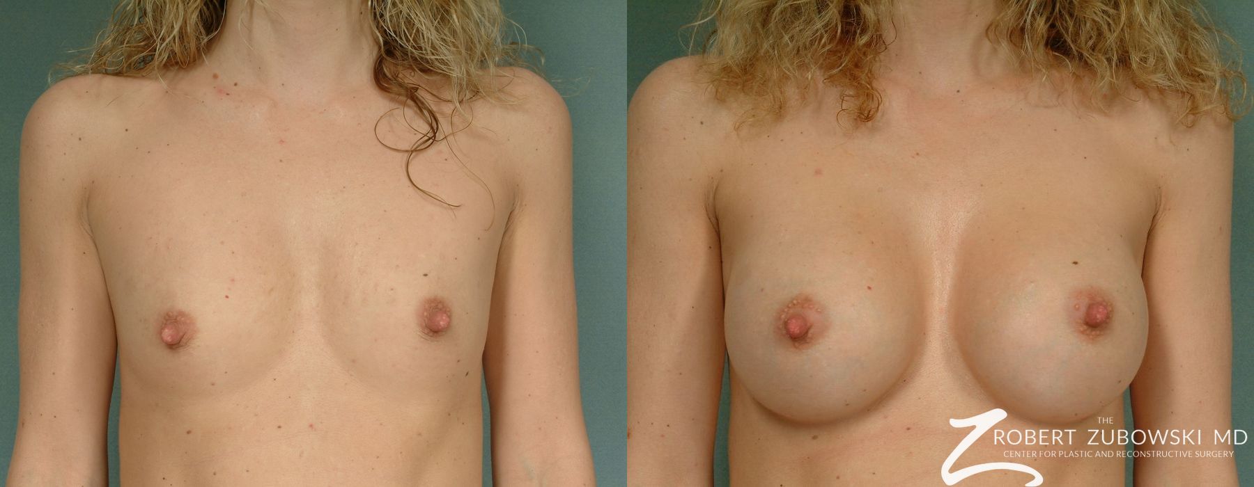 Breast Augmentation - Case 3625