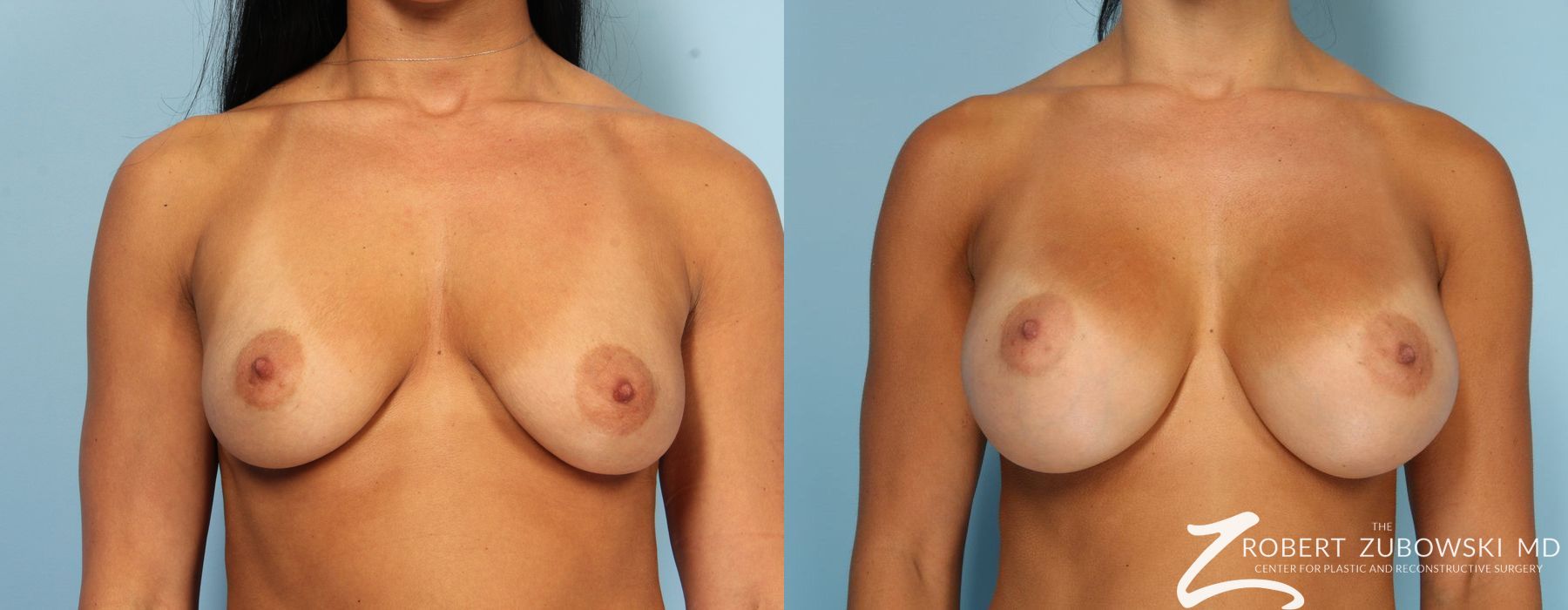Breast Augmentation - Case 3645