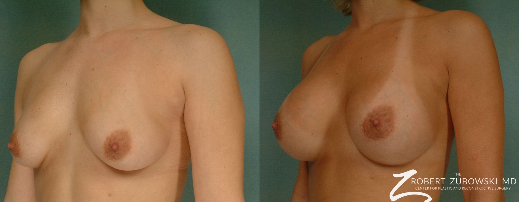 Breast Augmentation - Case 3629