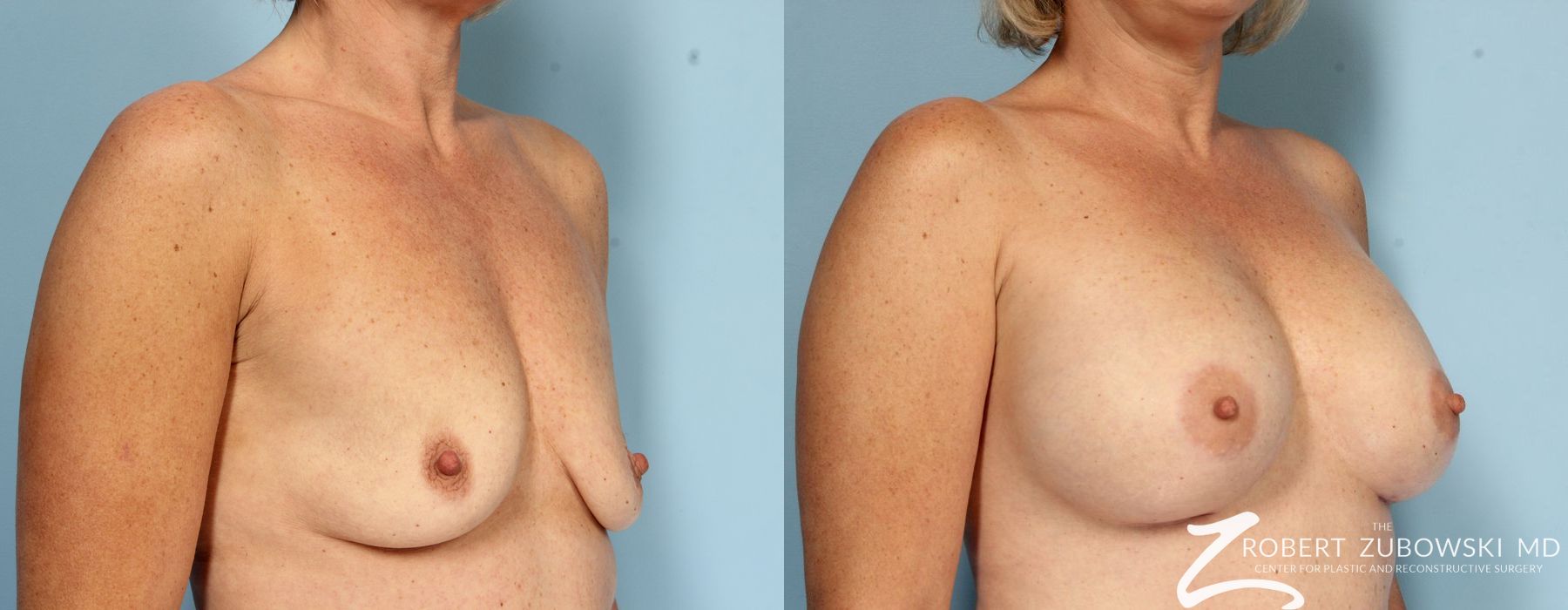 Breast Augmentation - Thumbnail 3