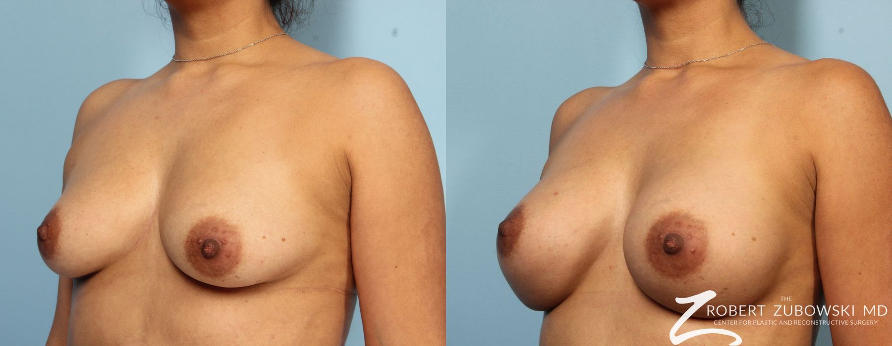 Breast Augmentation - Thumbnail 2