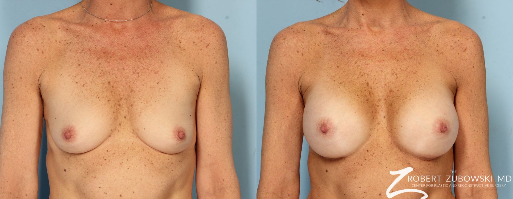 Breast Augmentation - Case 3643