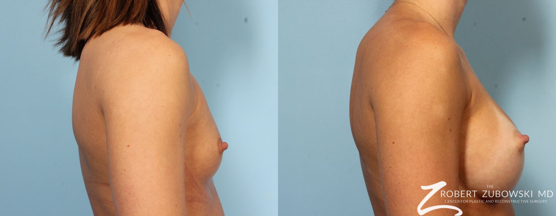 Breast Augmentation - Thumbnail 3