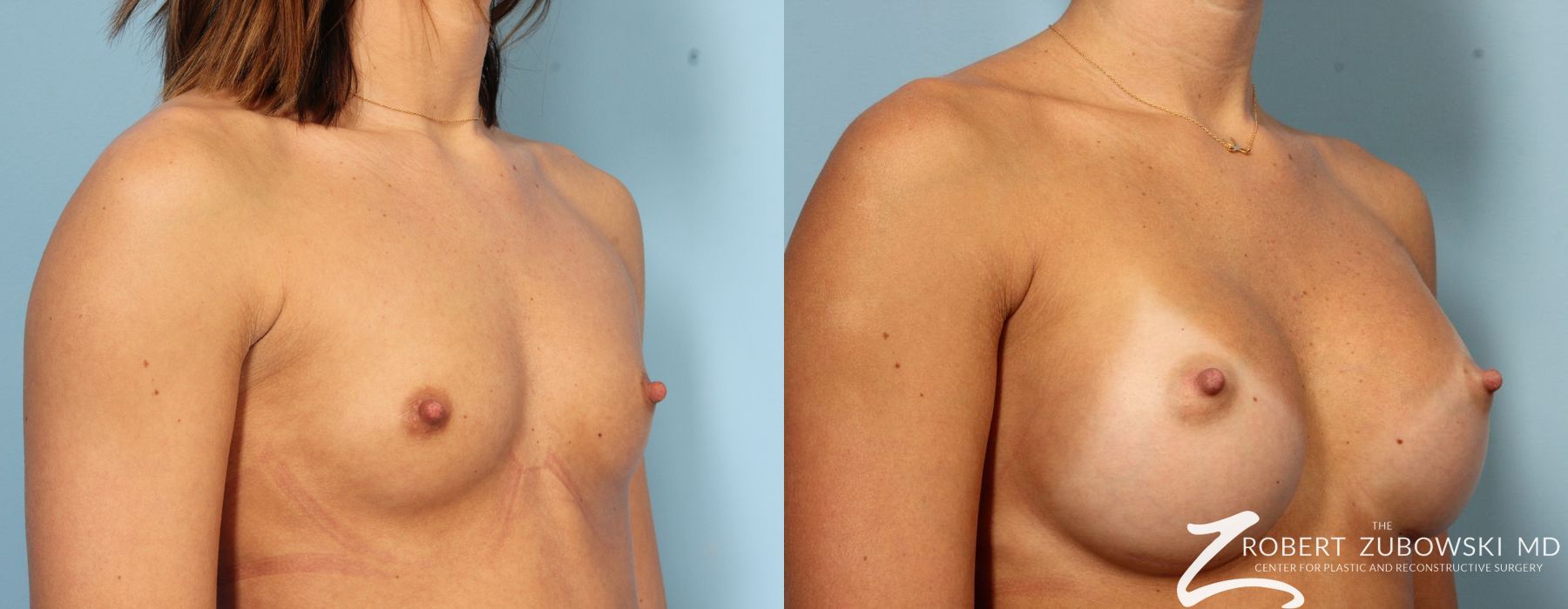 Breast Augmentation - Thumbnail 2