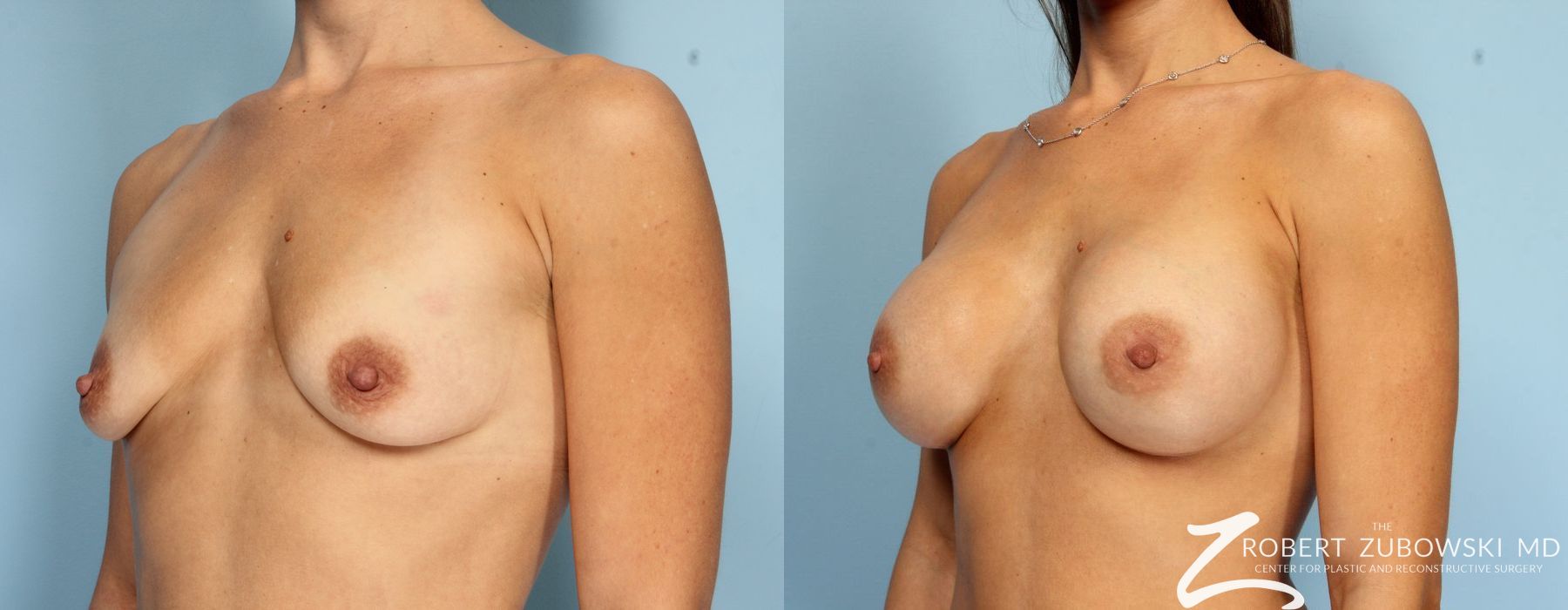 Breast Augmentation - Thumbnail 2