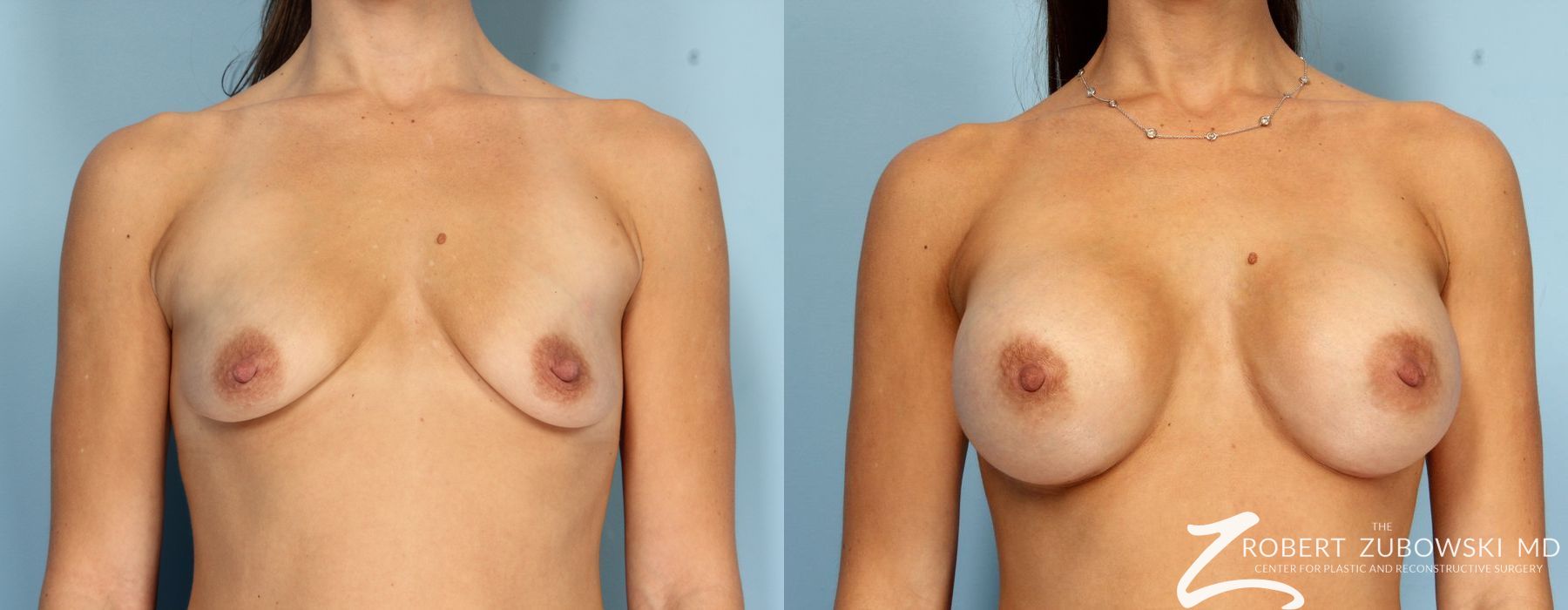 Breast Augmentation - Case 3638