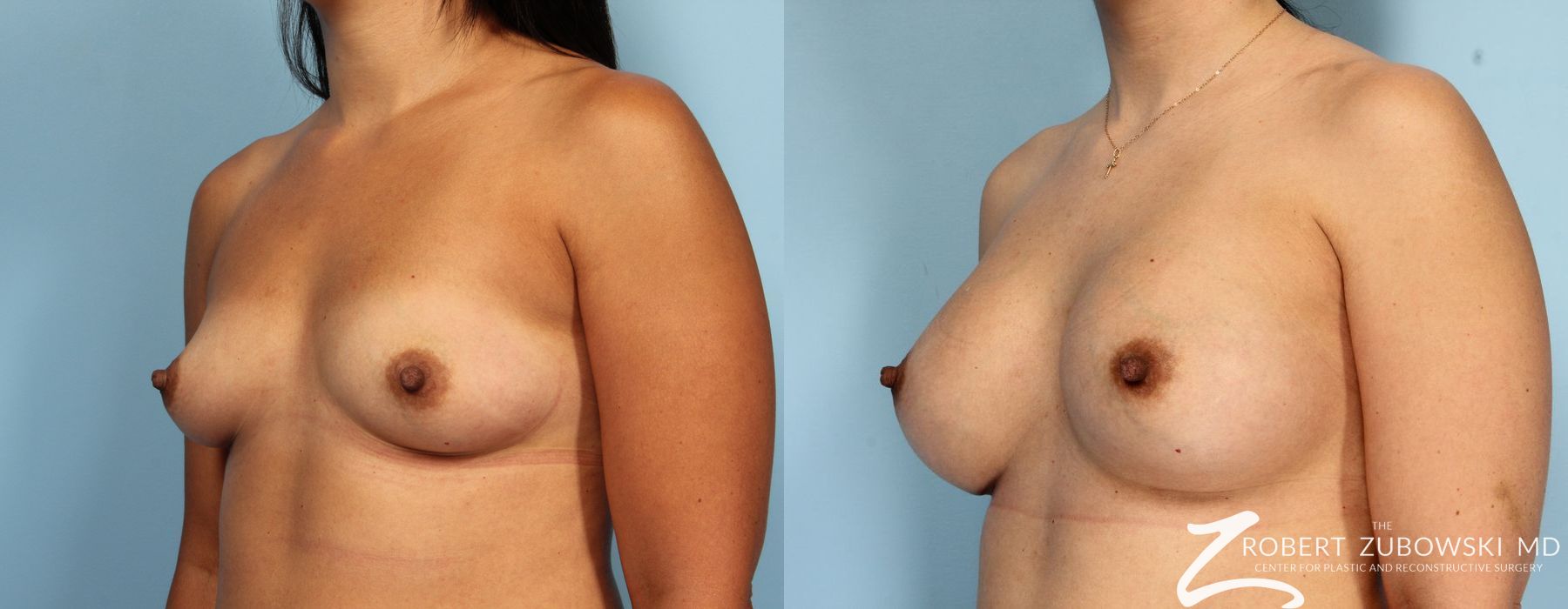 Breast Augmentation - Thumbnail 2