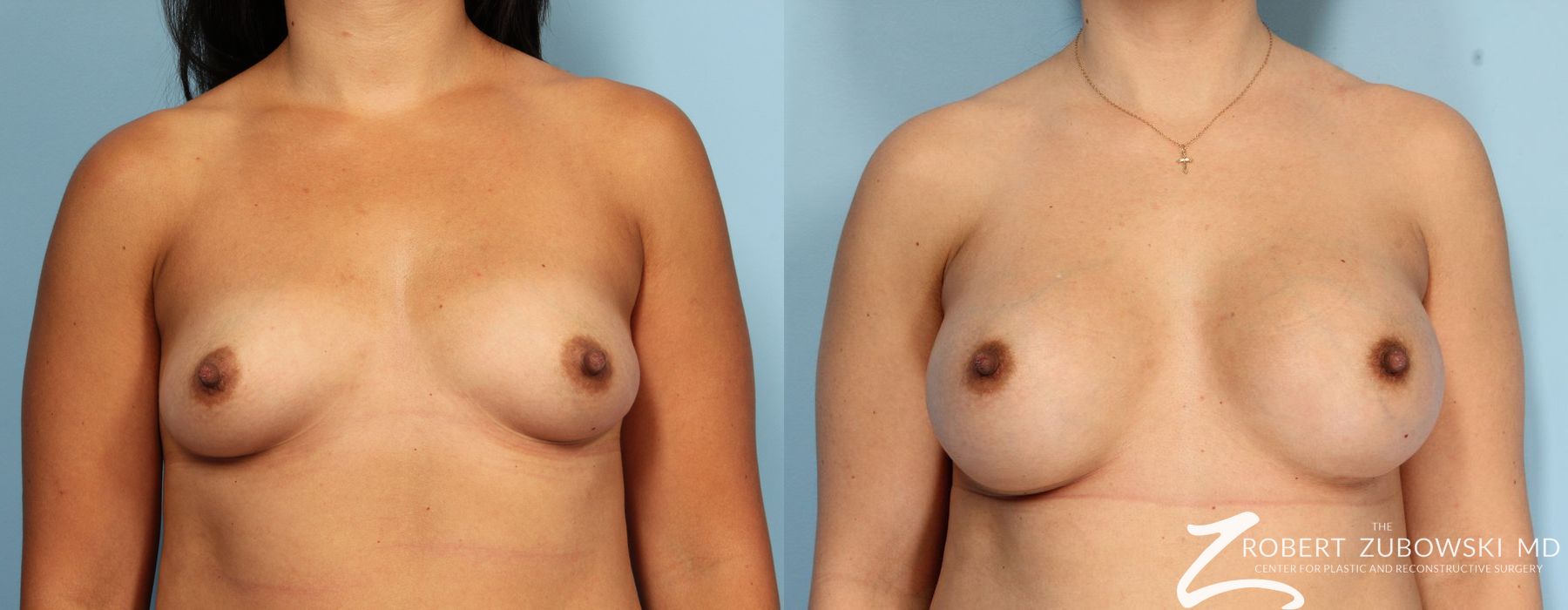 Breast Augmentation - Case 3637