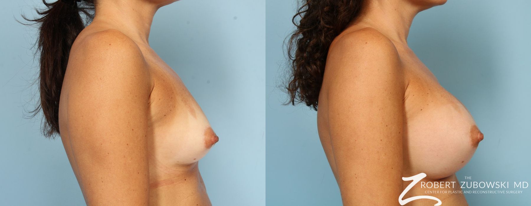 Breast Augmentation - Thumbnail 2