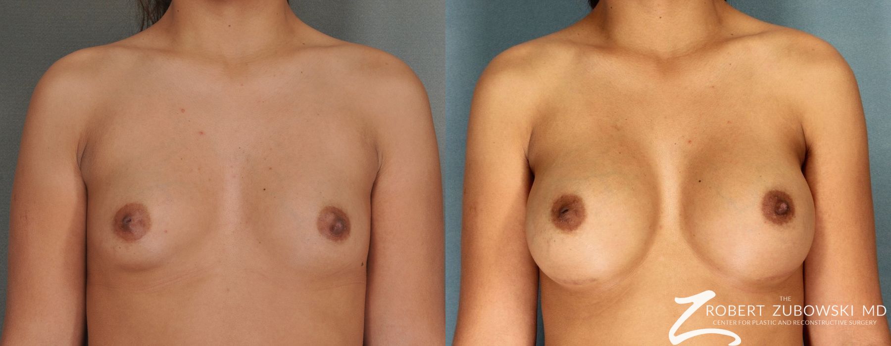 Breast Augmentation - Case 3613