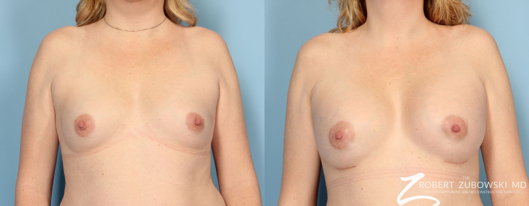 Before and after procedure result