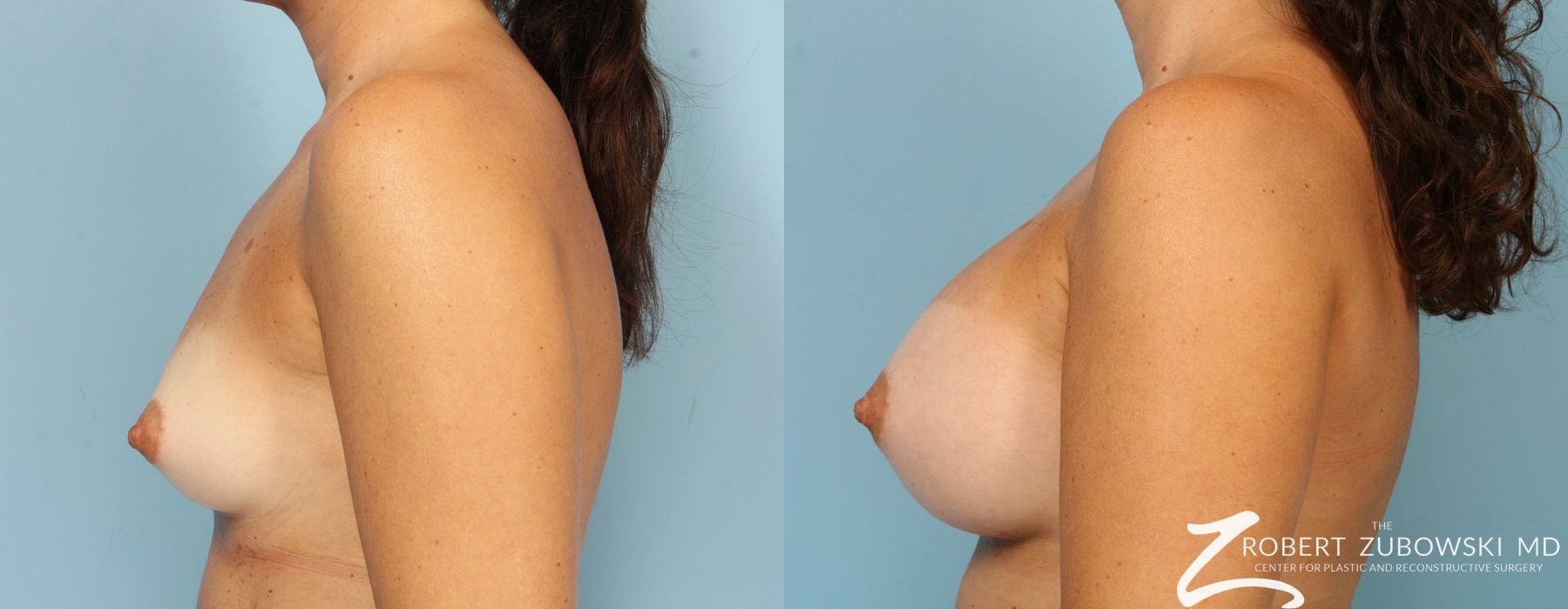 Breast Augmentation - Thumbnail 5