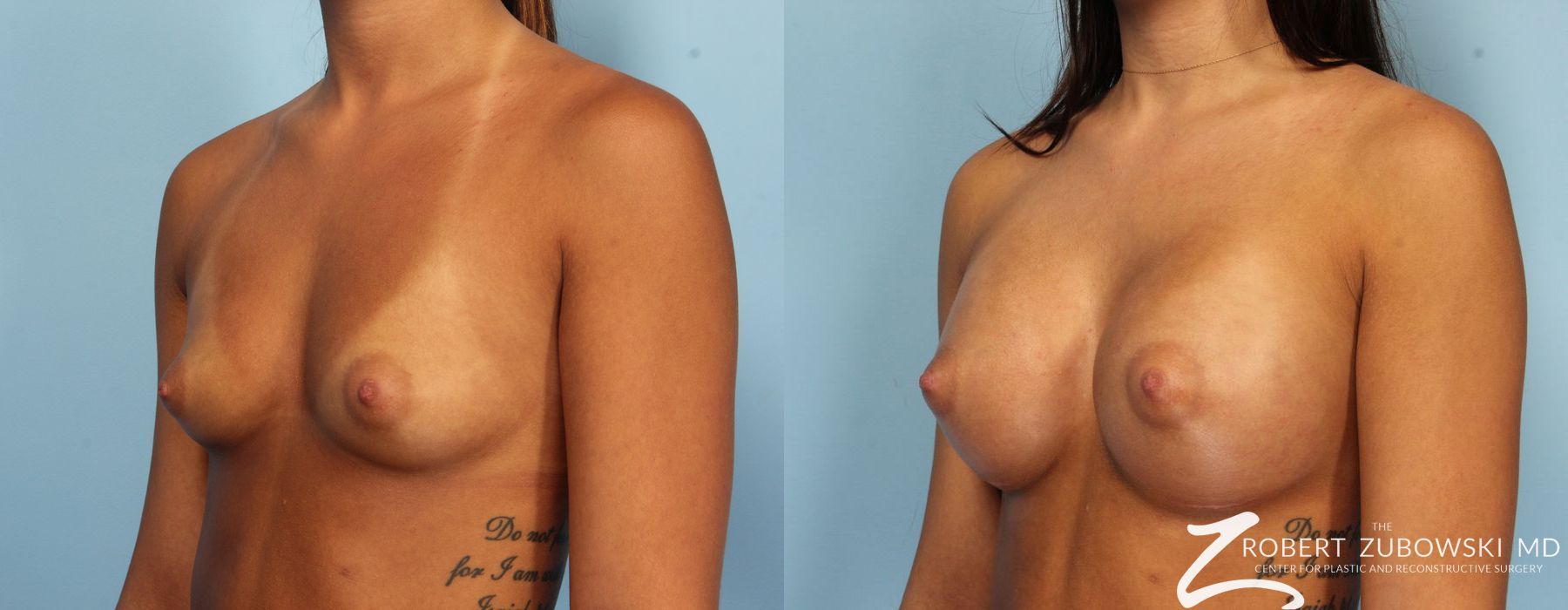 Breast Augmentation - Thumbnail 2
