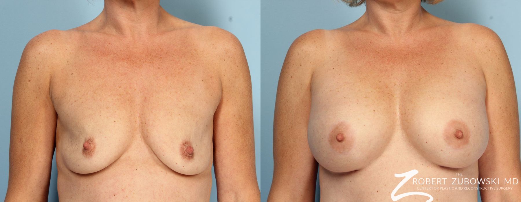 Breast Augmentation - Case 3642