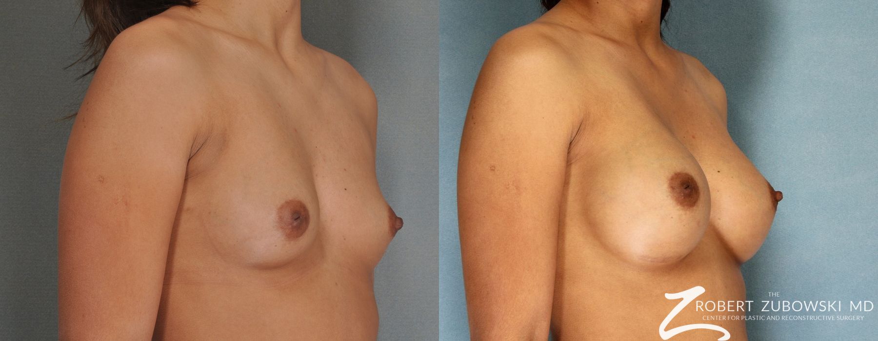 Breast Augmentation - Thumbnail 2