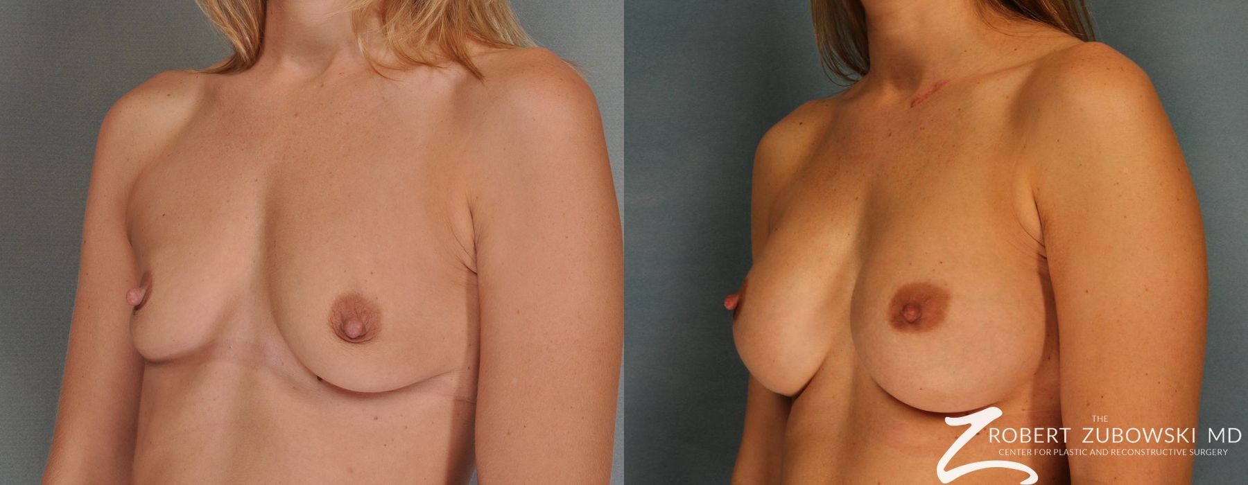 Breast Augmentation - Thumbnail 2