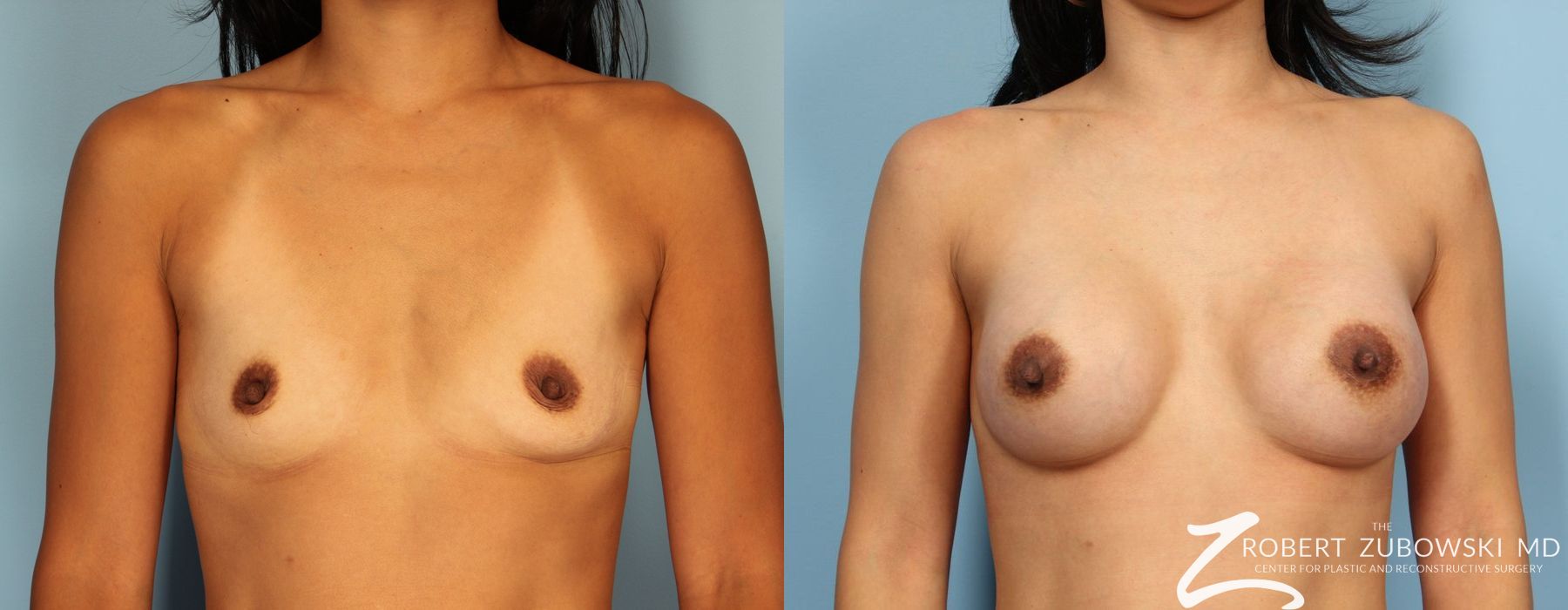 Before and after procedure result