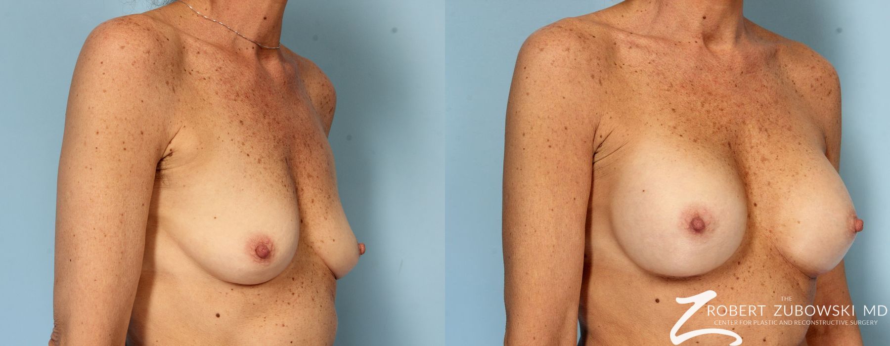 Breast Augmentation - Thumbnail 2