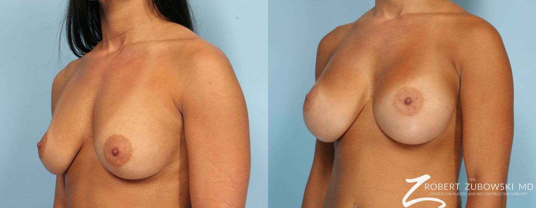 Breast Augmentation - Thumbnail 3
