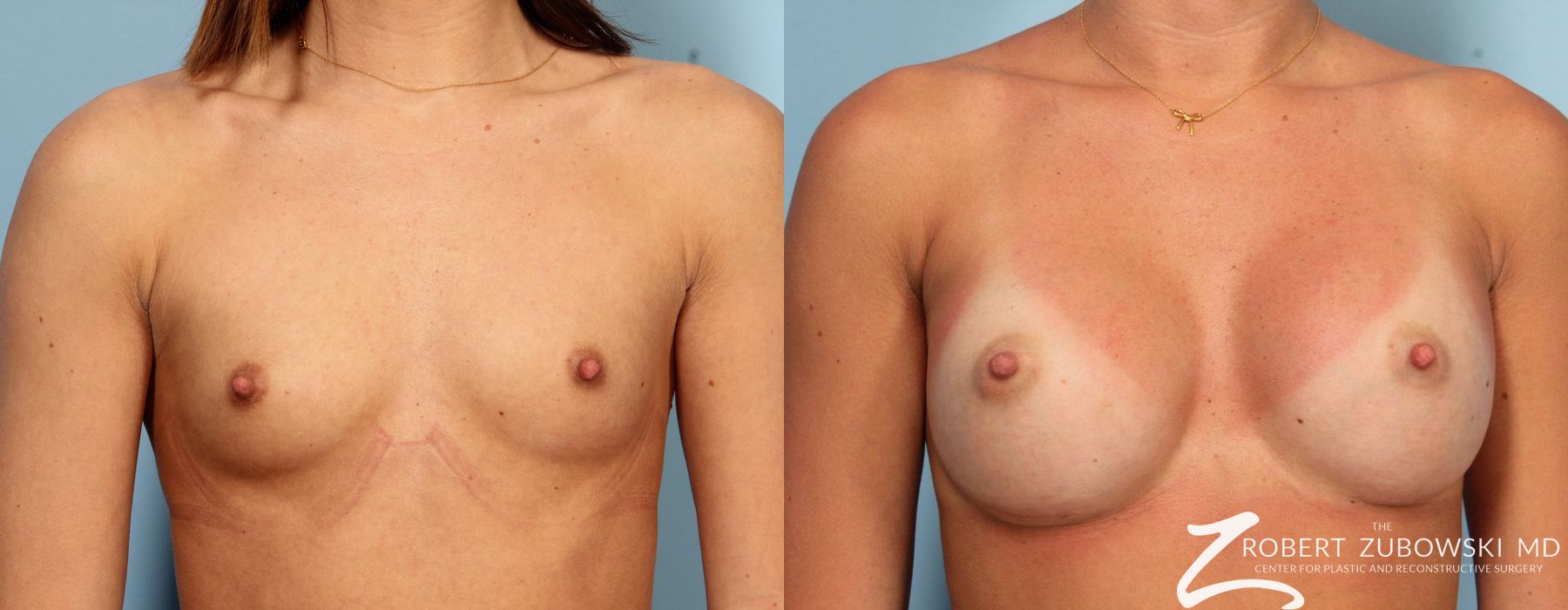 Breast Augmentation - Case 3641