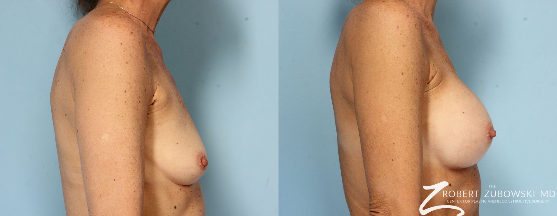 Breast Augmentation - Thumbnail 3