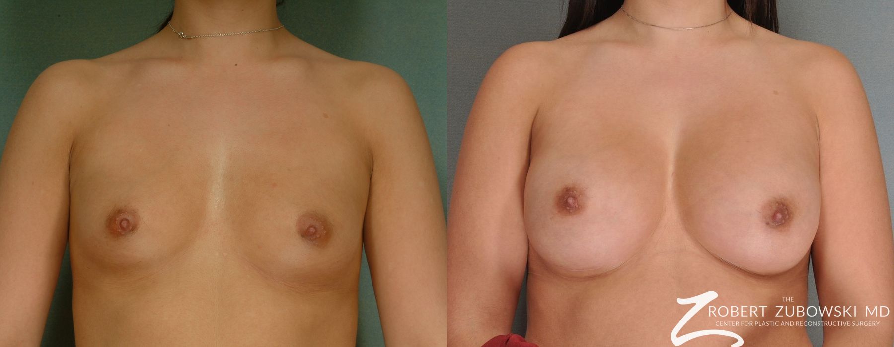 Breast Augmentation - Case 3618