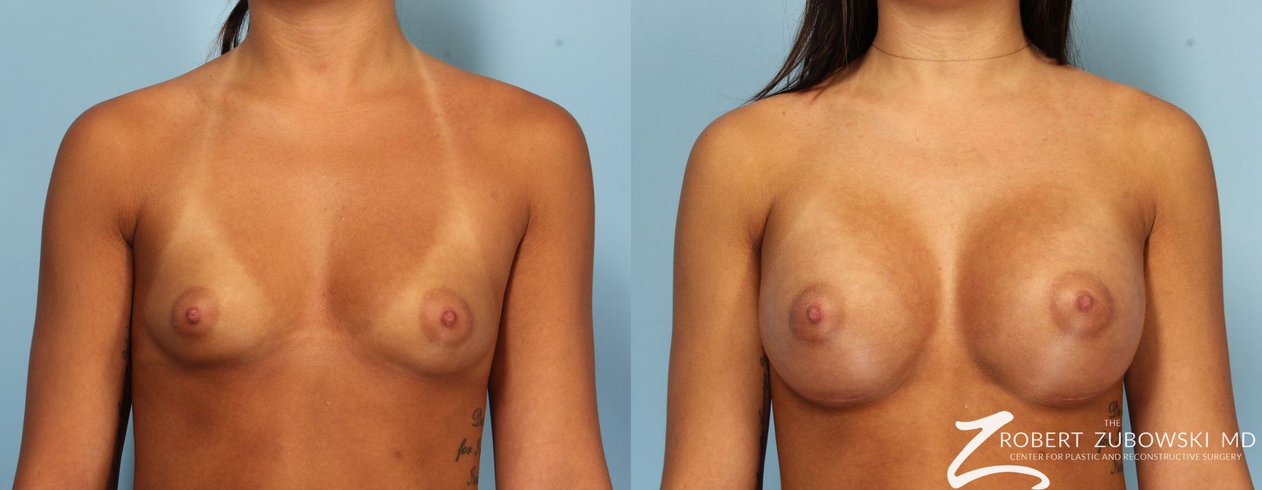 Breast Augmentation - Case 3639