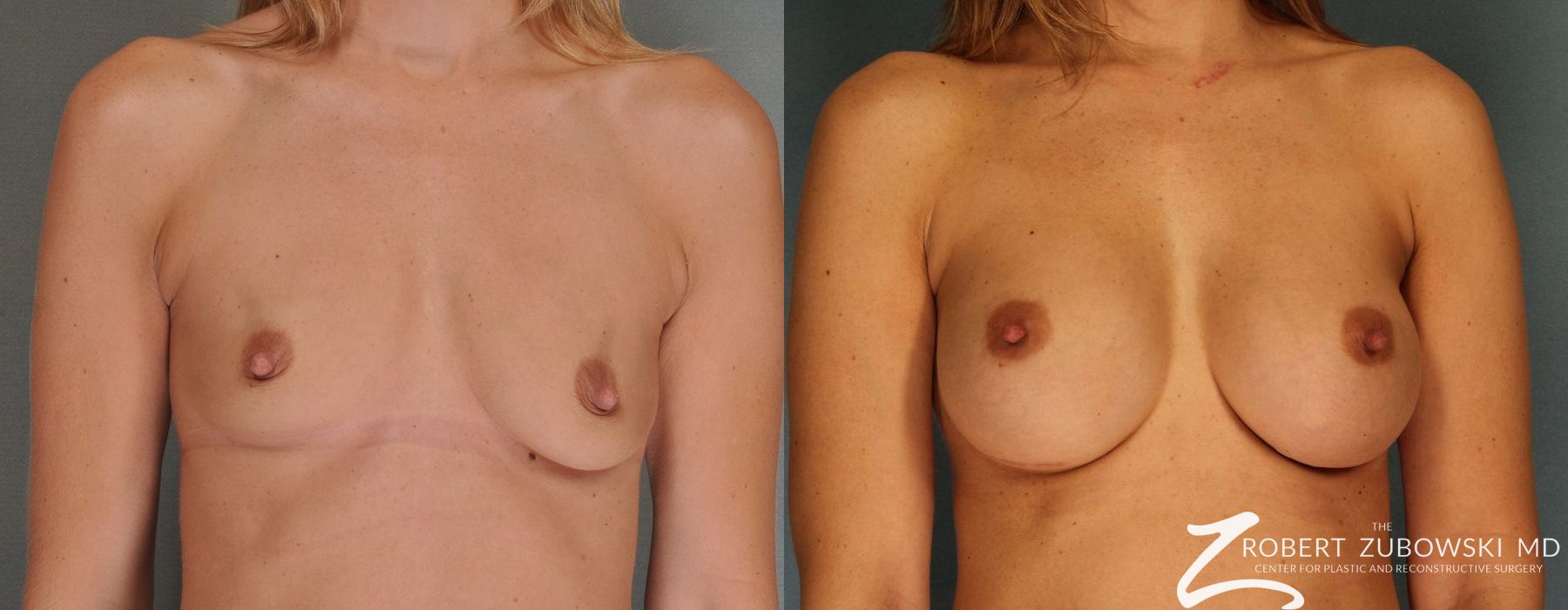 Breast Augmentation - Case 3615