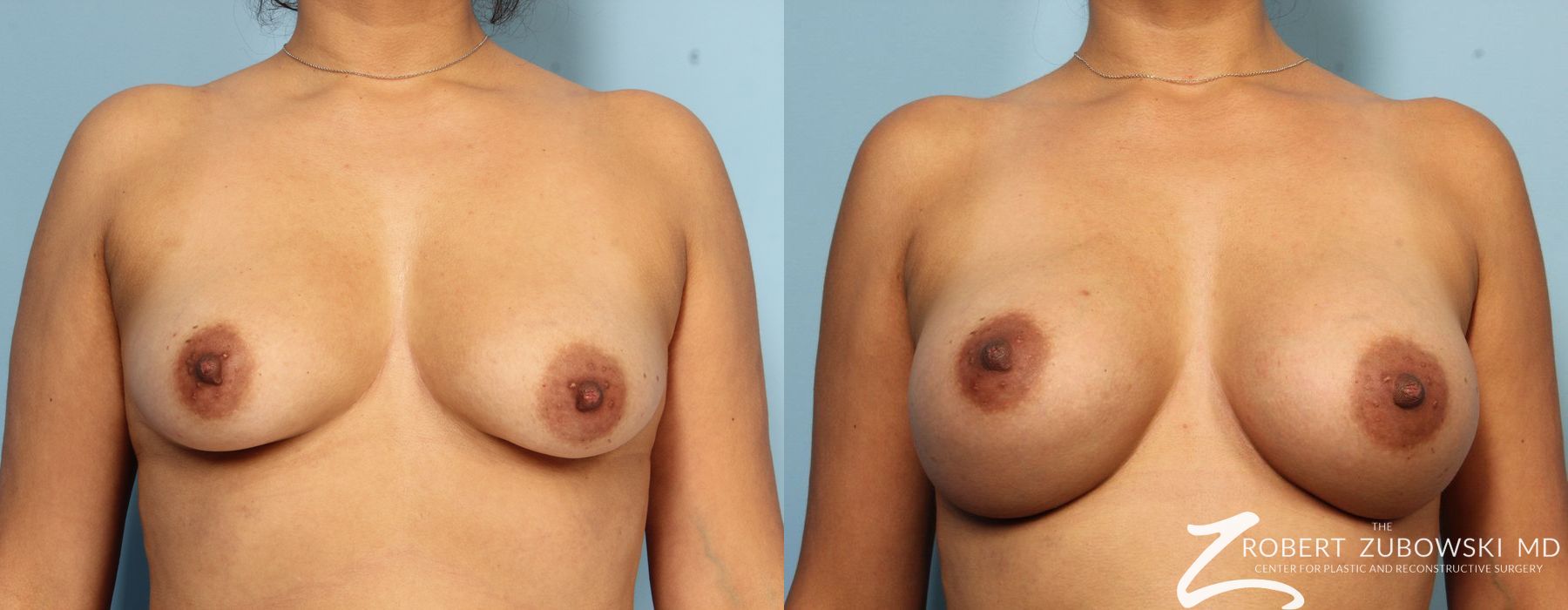 Breast Augmentation - Case 3640