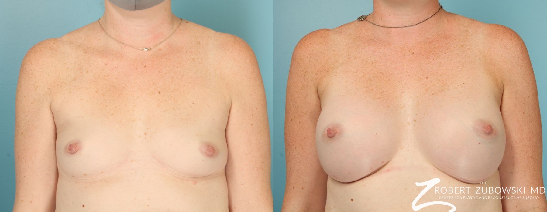 Breast Augmentation - Case 4100