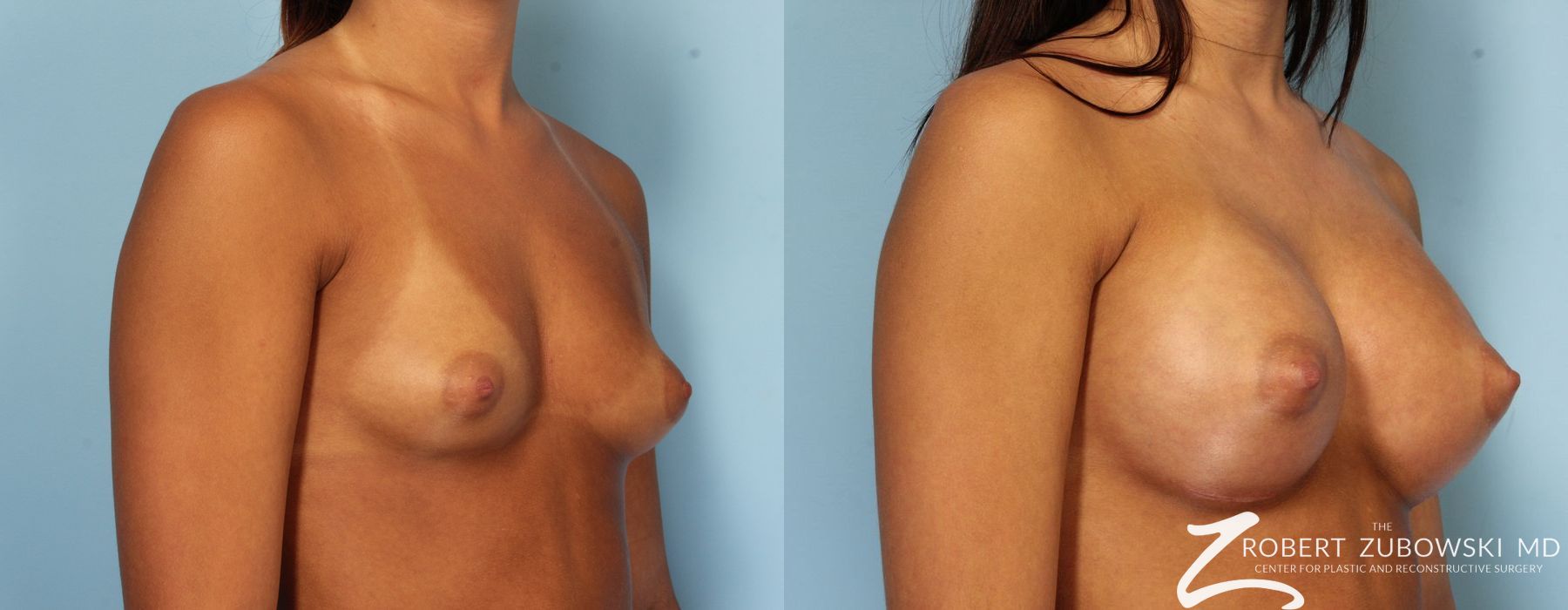 Breast Augmentation - Thumbnail 3