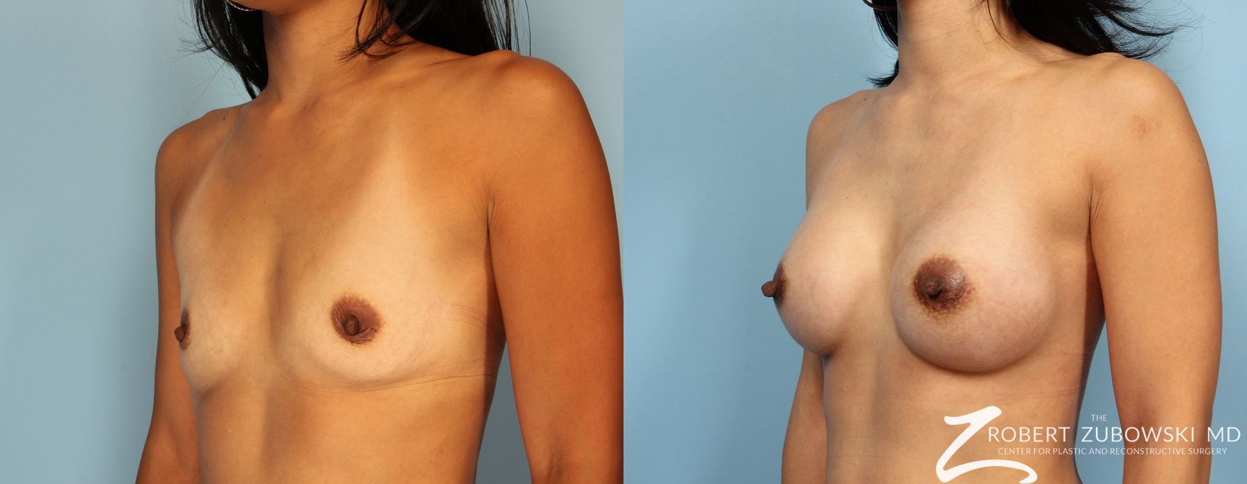 Breast Augmentation - Thumbnail 2