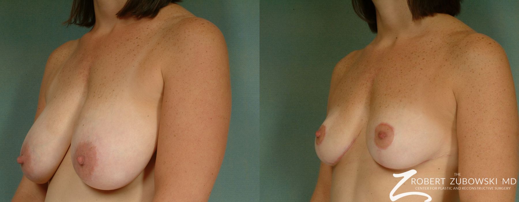Breast Lift - Thumbnail 2