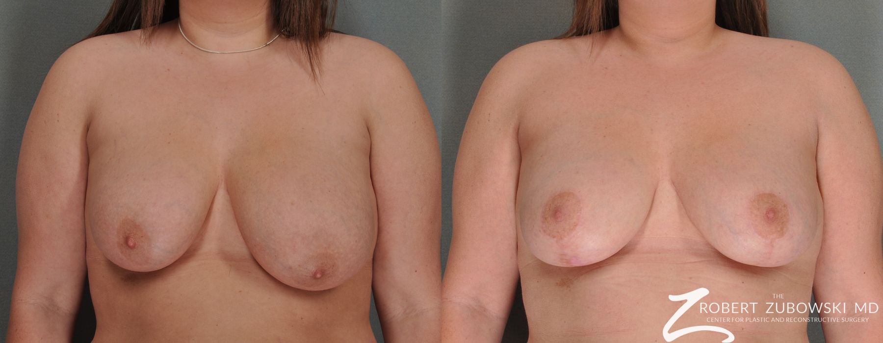 Breast Lift - Case 3657