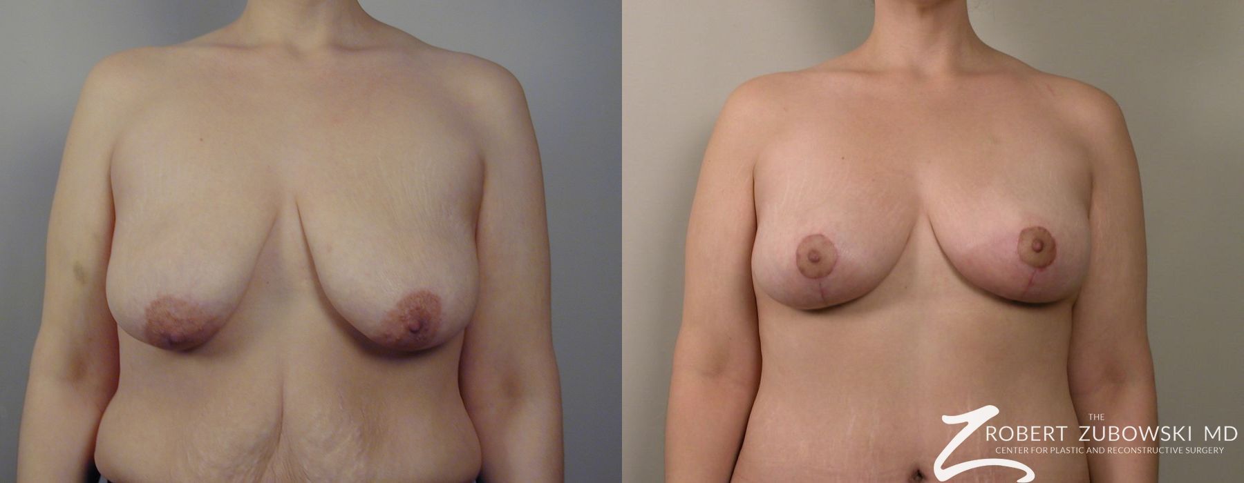 Breast Lift - Case 3651