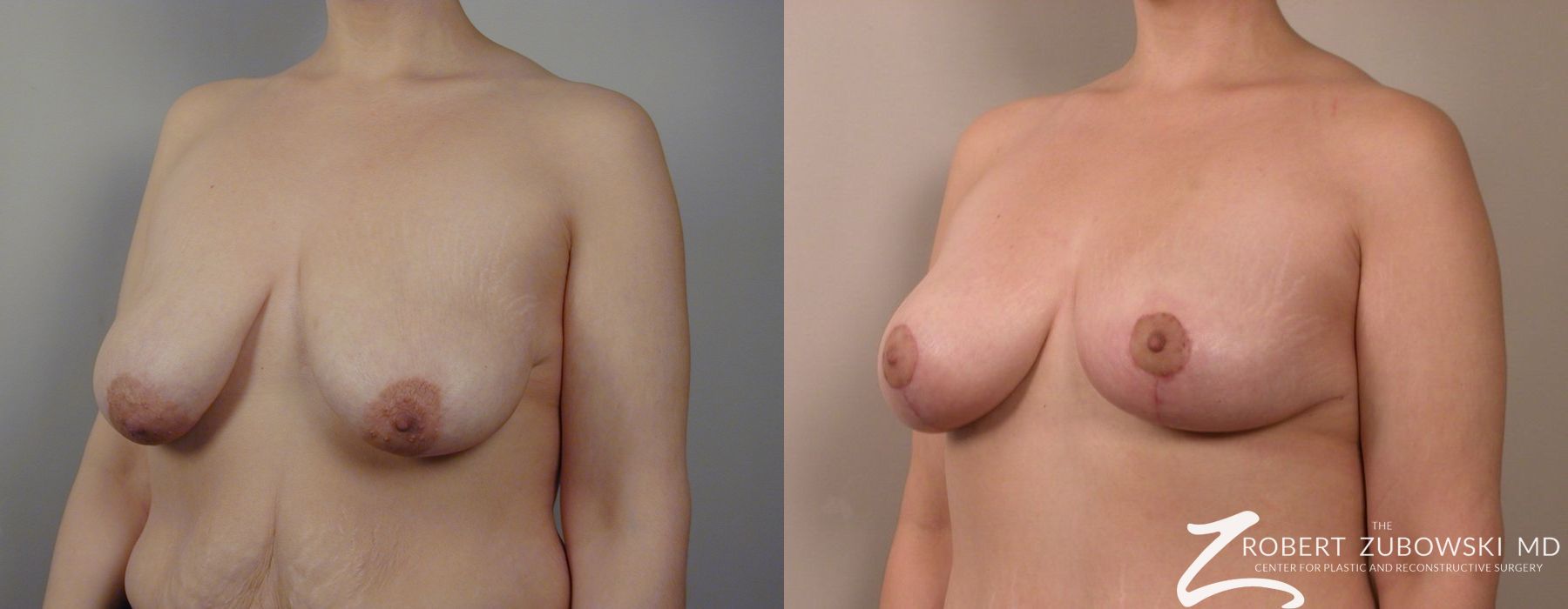 Breast Lift - Thumbnail 2