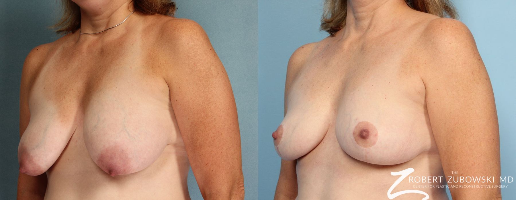 Before and after Breast Lift case 8208 - Angle 2